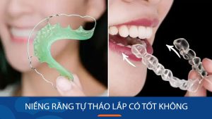 Niềng răng tự tháo lắp có tốt không? Những lưu ý quan trọng