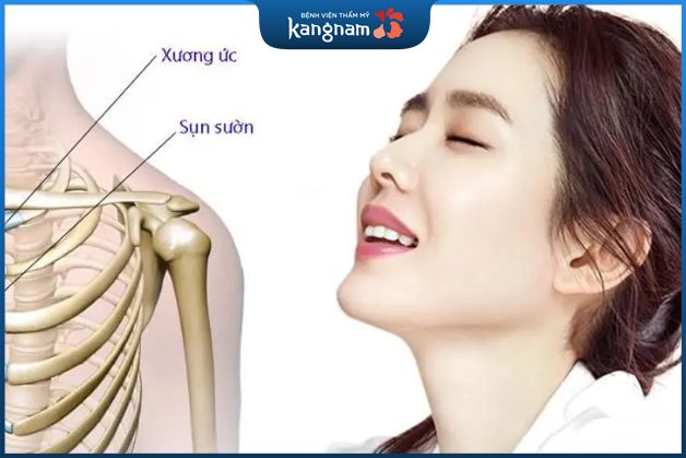 Nâng mũi sụn sườn