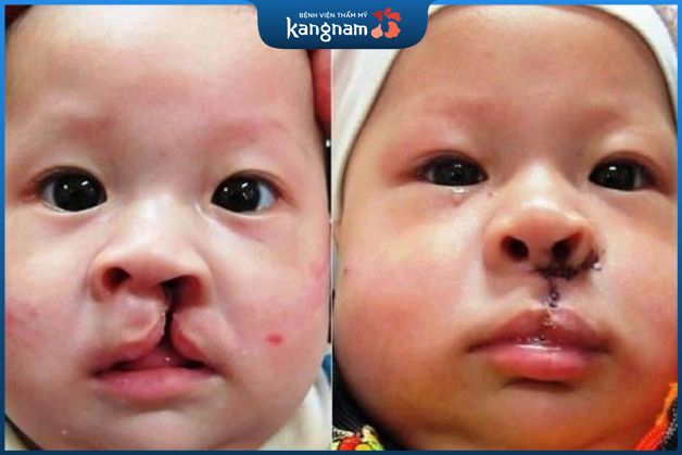 Hở hàm ếch hoàn toàn có thể chữa khỏi bằng phẫu thuật