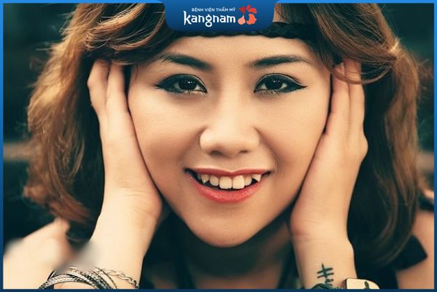 Răng khểnh là răng như thế nào?