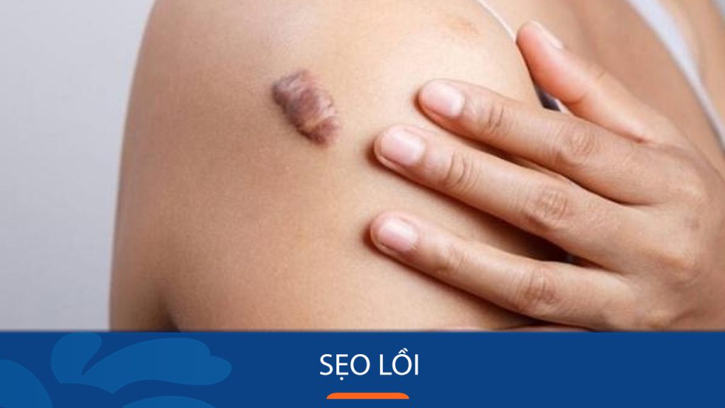 Bí quyết đánh bay sẹo lồi tận gốc – An toàn, Hiệu quả, Không đau