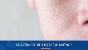 Sẹo lõm có điều trị được không? Loại bỏ hoàn toàn hay chỉ cải thiện? Giải đáp từ chuyên gia!