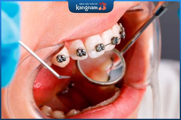 Niềng răng mắc cài sứ mất bao lâu