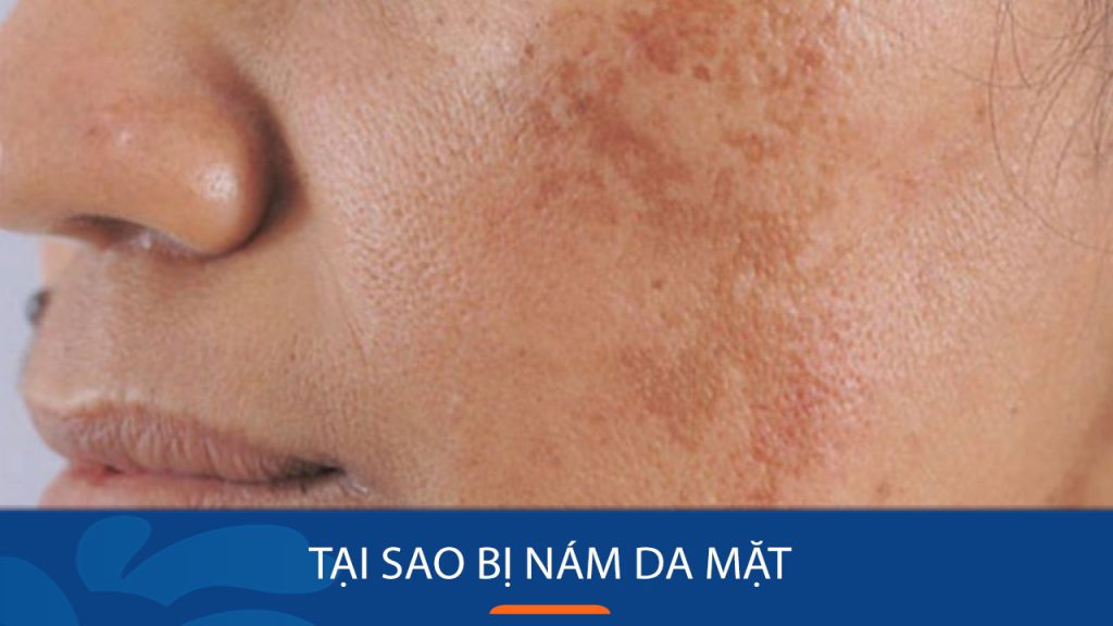 Tại sao bị nám da mặt? 8 Nguyên nhân gây nám