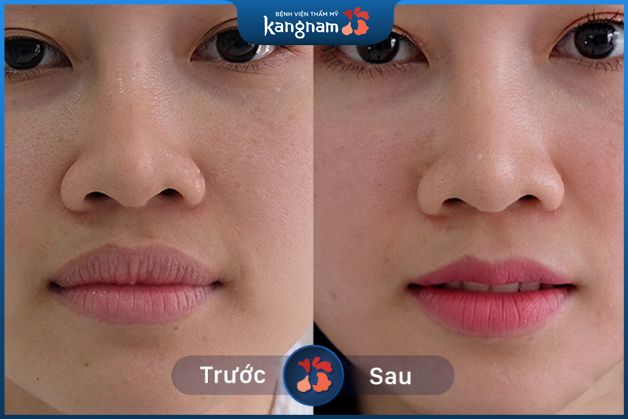 Tạo hình môi trái tim không đau, không dấu vết sẹo xấu