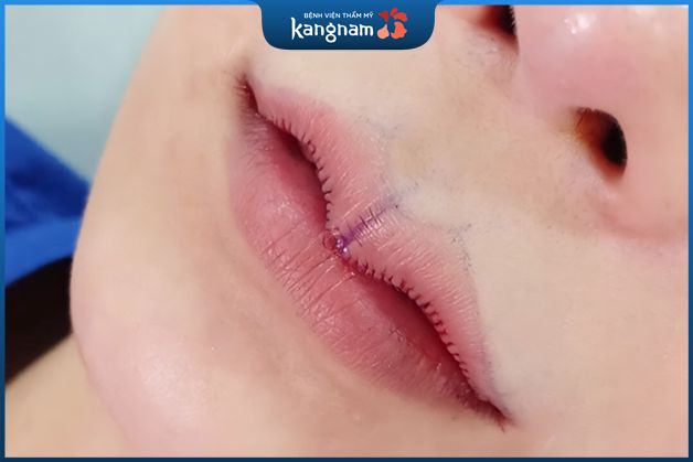 Thay đổi dáng môi tim đẹp tự nhiên tại Kangnam