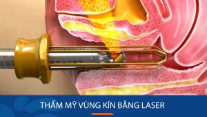 Thẩm mỹ vùng kín bằng laser: Đối tượng phù hợp, quy trình và cách chăm sóc