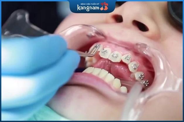 Thời gian đeo niềng tùy vào từng độ tuổi