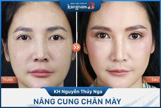 Nhan sắc trẻ trung tự nhiên sau khi treo chân mày