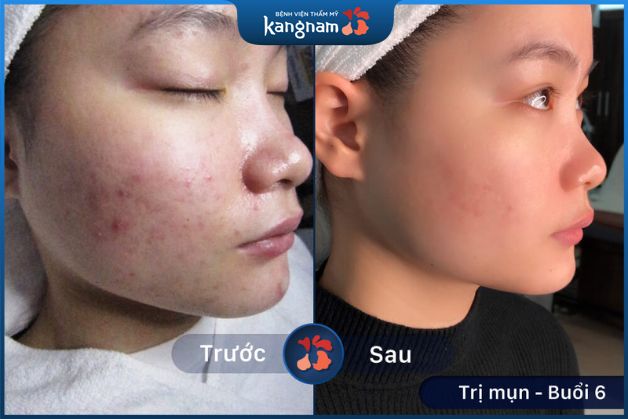 Trị sạch mụn đến 95%