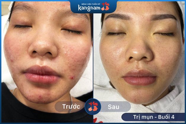 Loại bỏ mụn, da thoáng sạch, khỏe khoắn