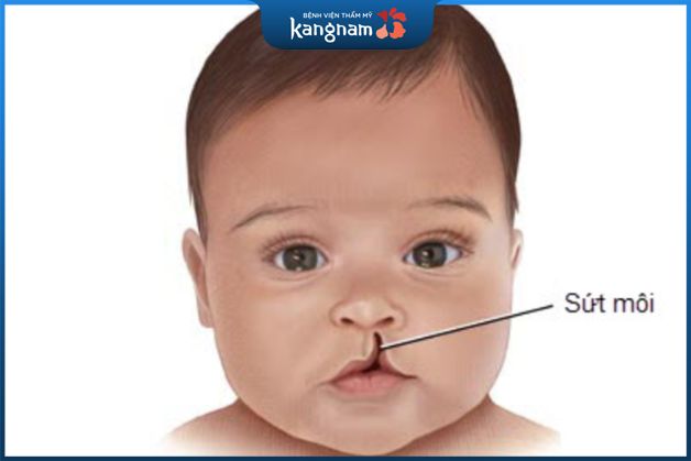 Việc phẫu thuật hở hàm ếch cho trẻ cần được thực hiện trong thời gian phù hợp