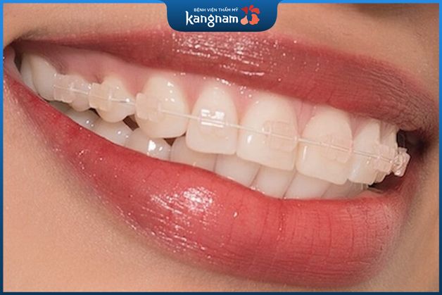 Những ưu điểm niềng răng mắc cài sứ