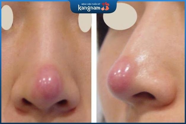 Vận động mạnh có thể gây biến chứng mũi