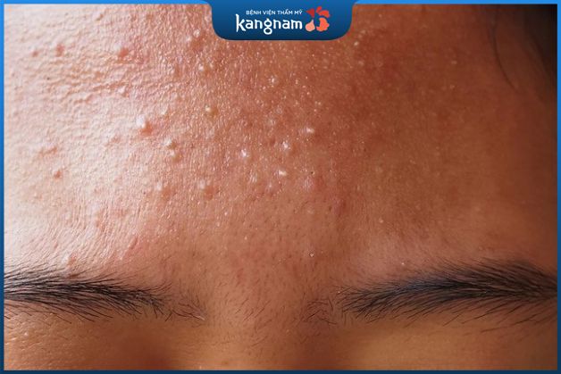 Vị trí xuất hiện mụn ẩn