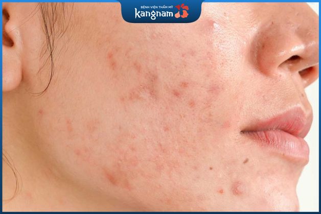 Sẹo thâm hình thành do nhiều nguyên nhân