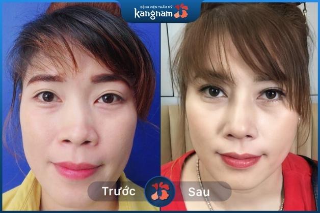 Gương mặt "lột xác" sau khi chỉnh hình xương mũi