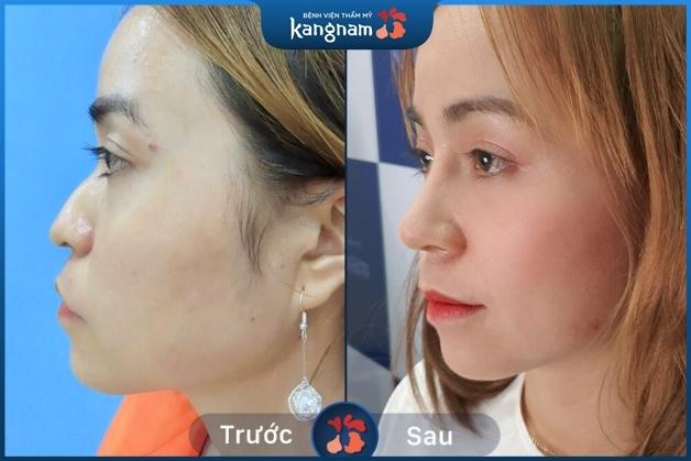 Khách hàng mài gồ chỉnh xương nâng mũi đạt kết quả như ý