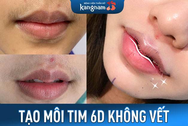 Tạo môi tim 6D - Công nghệ tạo hình môi không dấu vết độc quyền tại Kangnam