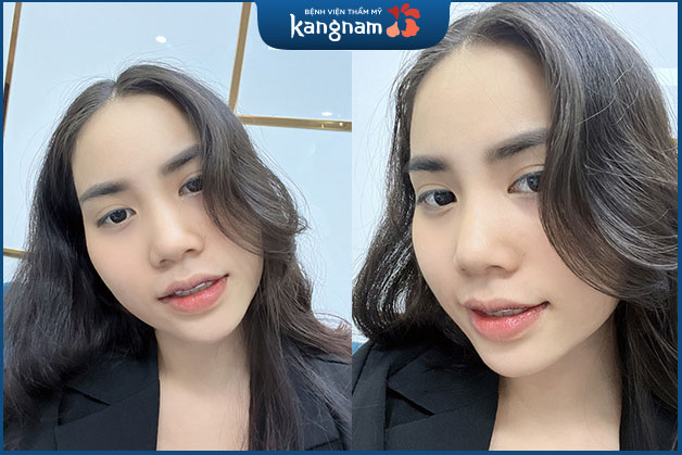 Khách hàng tạo hình môi tim 6D, không để lại sẹo xấu