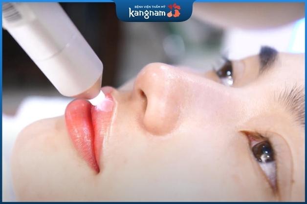 Thẩm mỹ môi sử dụng công nghệ Plasma