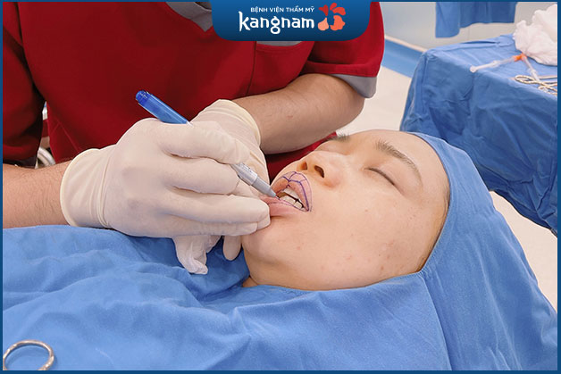 Bác sĩ đo vẽ Tạo môi tim 6D theo tỷ lệ gương mặt