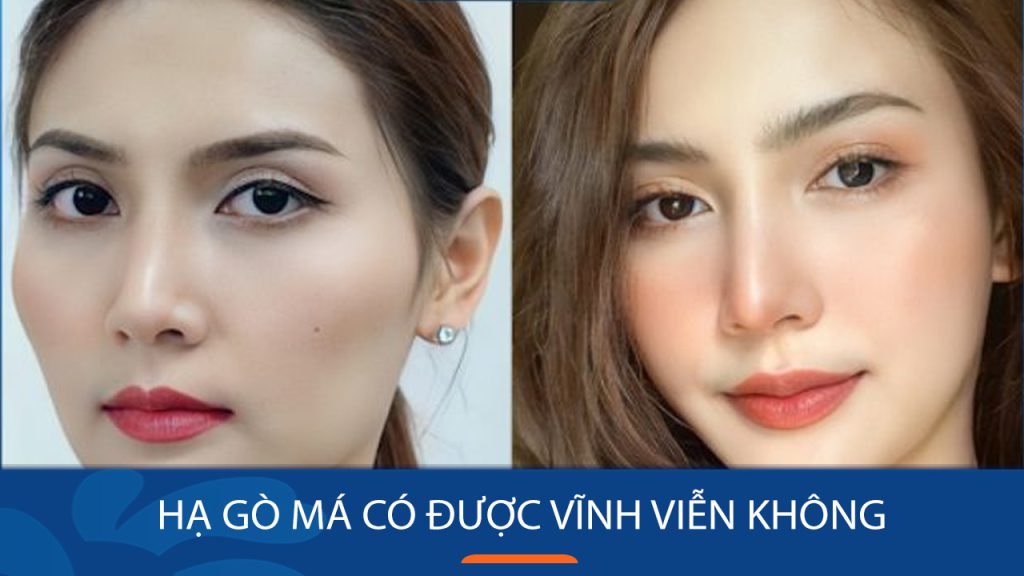 Hạ gò má có được vĩnh viễn không? cần lưu ý điều gì