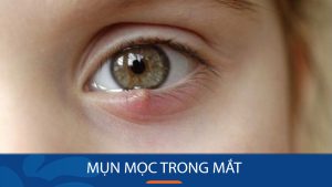 Mụn mọc trong mắt: Nguyên nhân, triệu chứng và cách điều trị