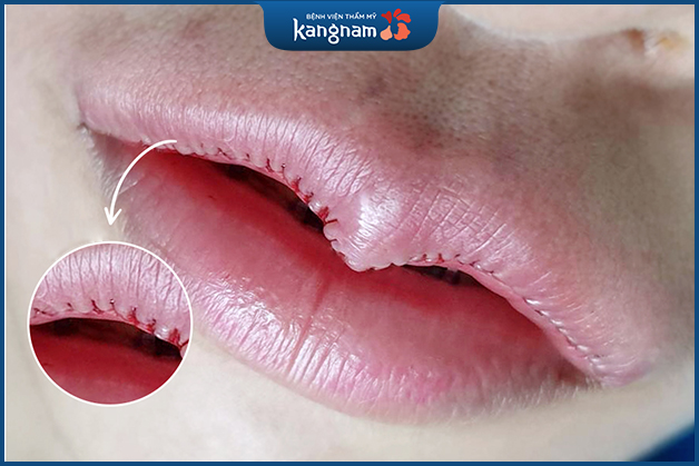 Chỉ Nano vi phẫu siêu mảnh hạn chế tối đa sẹo