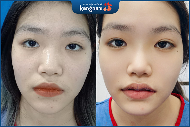 Khách hàng hồi phục nhanh sau tạo hình môi tim 6D