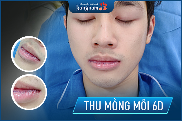 Thu mỏng môi 6D sử dụng chỉ Nano siêu mảnh 0,01mm