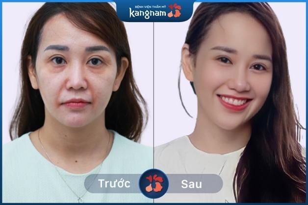 Tự tin với làn da trẻ trung sau khi đến với Kangnam