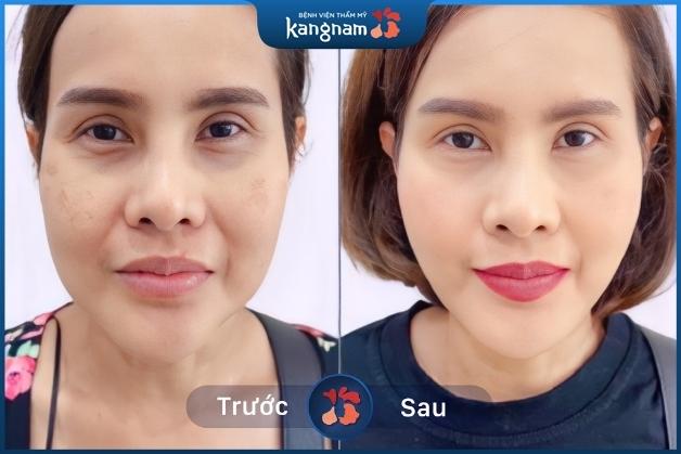 Căng da Mi Young đẹp tự nhiên