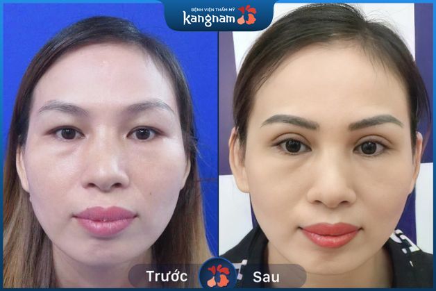 Mí nhanh lành và đẹp tự nhiên