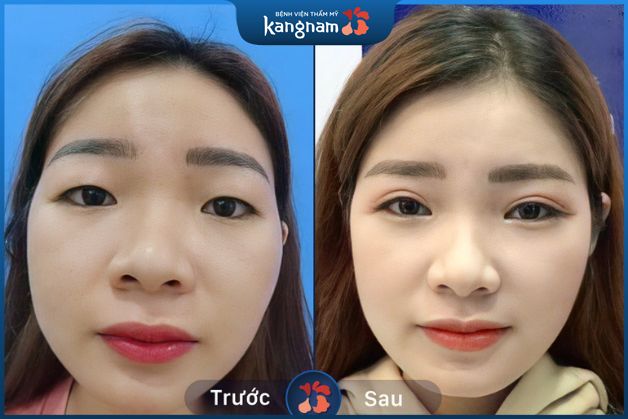 Gương mặt sau khi cắt mí trở nên sắc nét