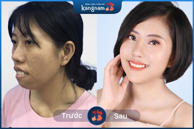 Hàm hô quá mức khiến ngoại hình kém hấp dẫn