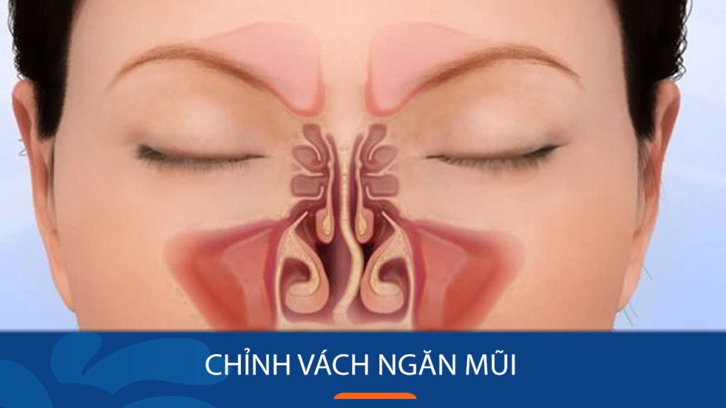 Chỉnh vách ngăn mũi là gì? Khi nào cần phẫu thuật và những điều cần biết