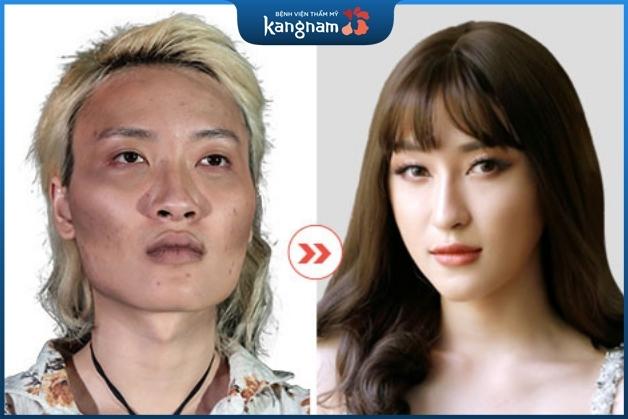 Sau hạ gò má kết quả sẽ duy trì vĩnh viễn