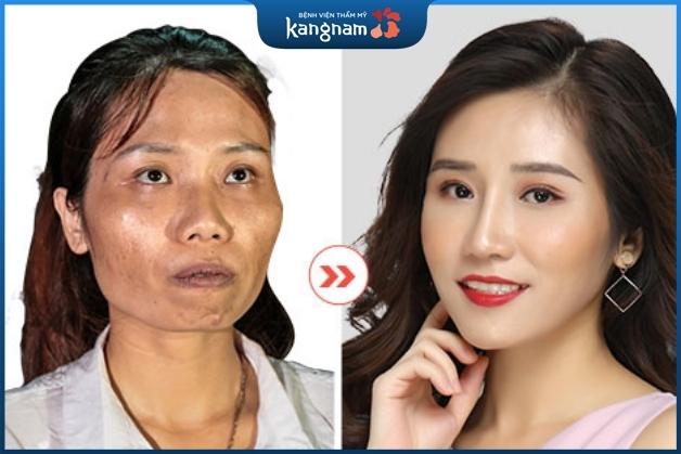 Khách hàng trở nên tươi tắn, xinh xắn và nữ tính hơn sau khi hạ gò má