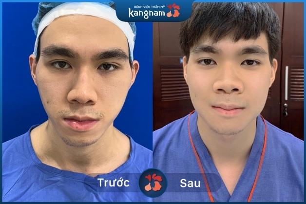 Khách hàng nam hạ gò má giúp gương mặt cân đối hơn