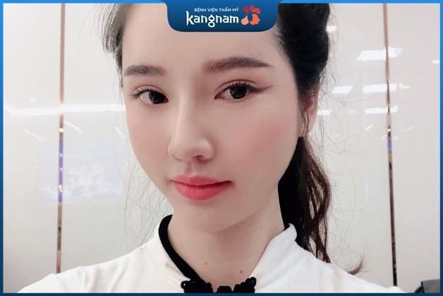 Nét mặt tươi tắn nữ tính hơn sau khi hạ gò má