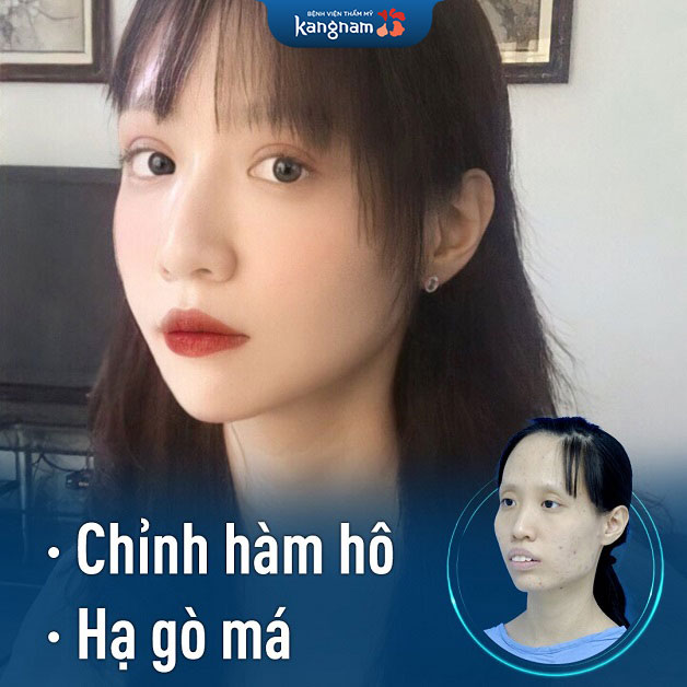 Kết hợp chỉnh hàm hô và hạ gò má mang lại kết quả tốt nhất cho khách hàng