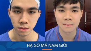 Hạ gò má nam giới: Bí quyết sở hữu khuôn mặt góc cạnh, nam tính