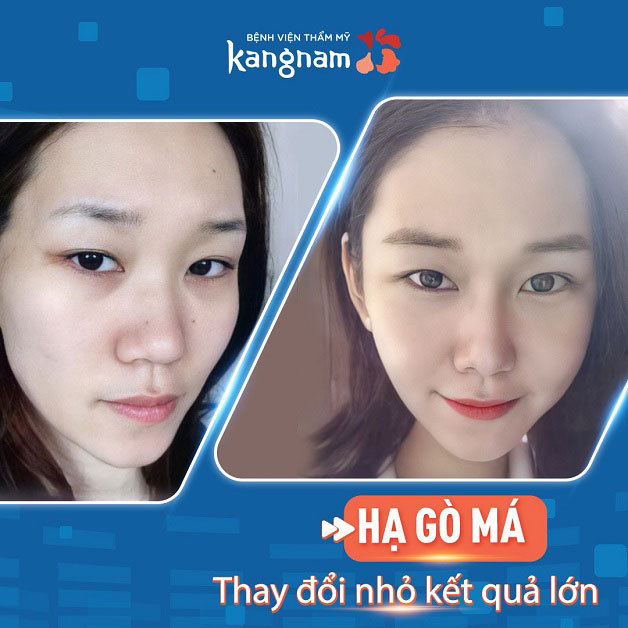 Hạ xương gò má có đau không