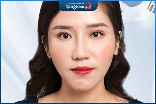 Phẫu thuật hạ gò má mang đến kết quả vĩnh viễn