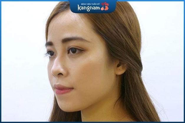 Người có mũi gồ, lệch, vẹo cần thực hiện thủ thuật nắn chỉnh xương