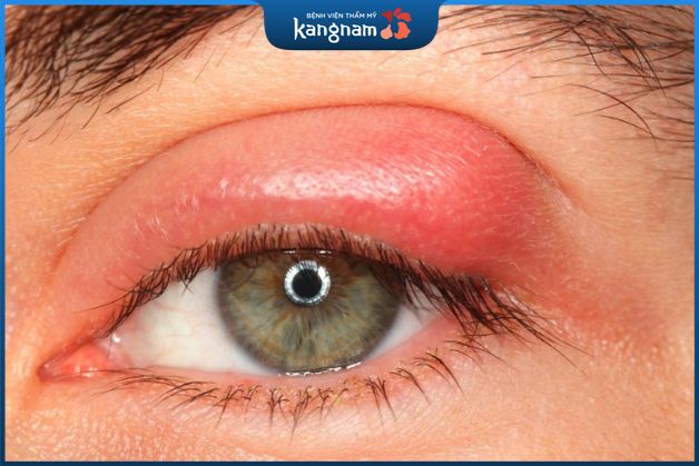 Mụn mọc trong mắt do bị chắp