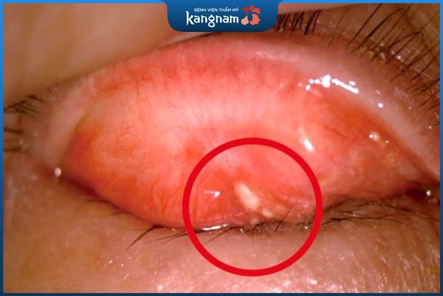 Nổi mụn trong mắt do bị sạn vôi