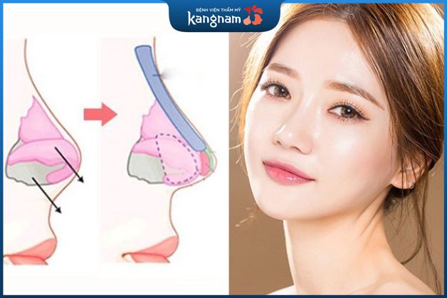 Nâng mũi bọc sụn là gì?