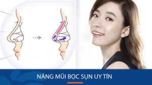 Nâng mũi bọc sụn uy tín